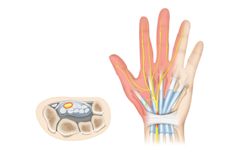 수근관 증후군